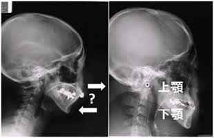 上顎下顎の関係