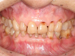 図5 強い歯ぎしりを認める患者さん